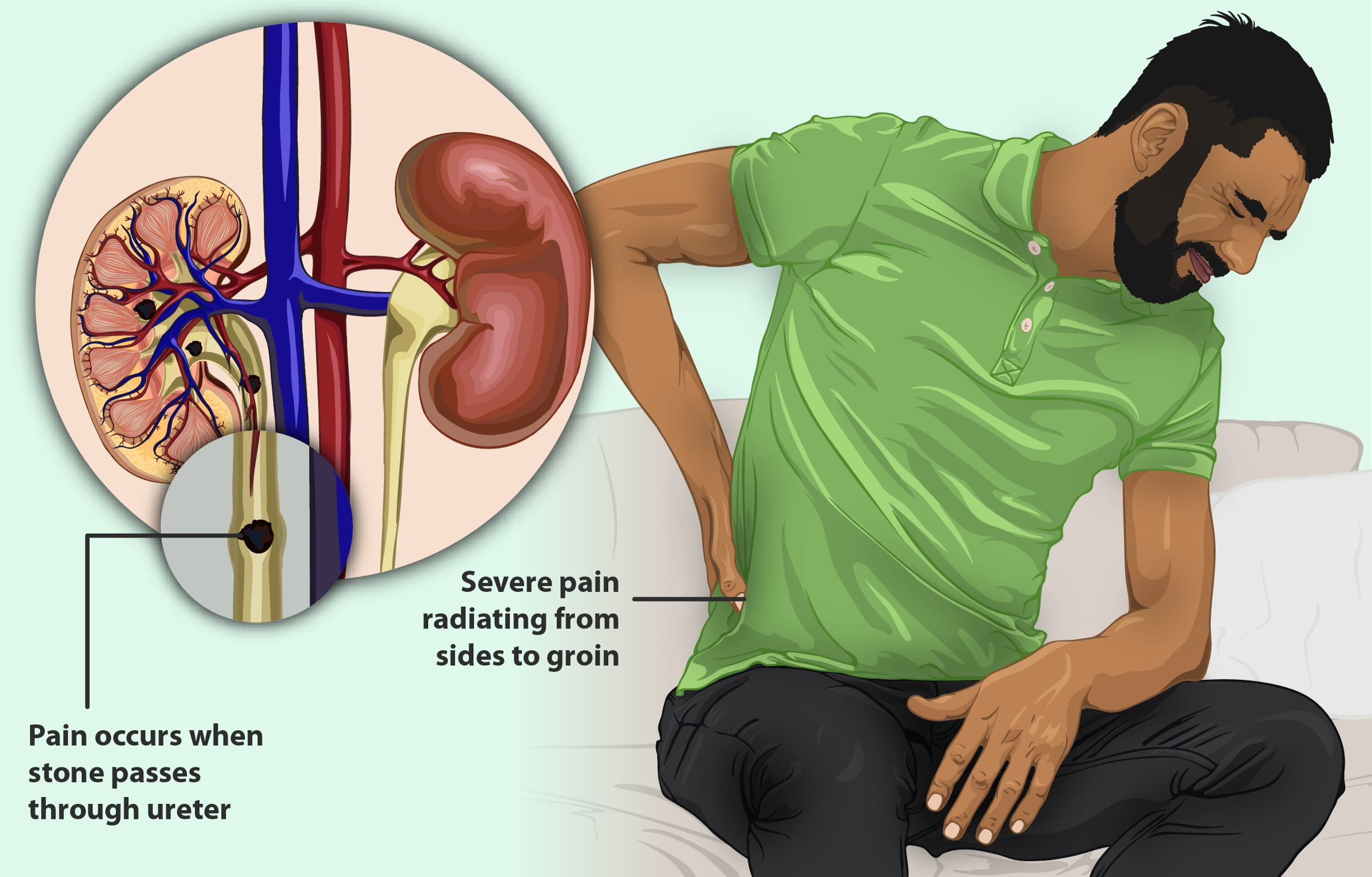 Kidney Stone - Symptoms, Causes and Treatment